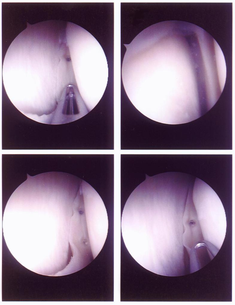 screws on meniscus inside David's  knee